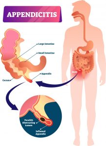 Laparoscopic Appendectomy