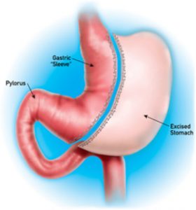 Revision Bariatric Surgery delhi