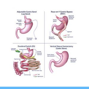 Revision Bariatric Surgery