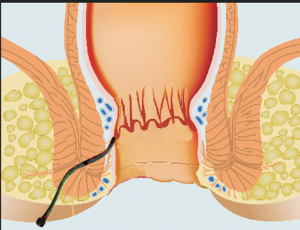 Causes of Fistula