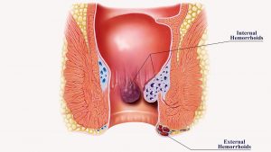 Symptoms of Piles